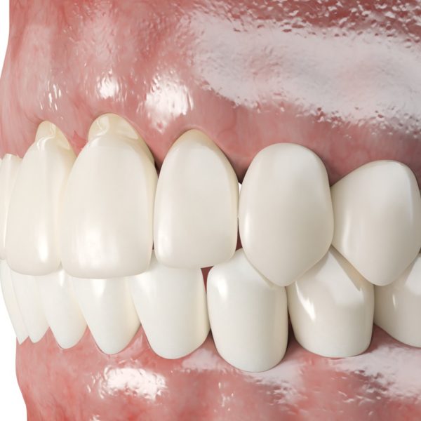 Can receding gums grow by themselves