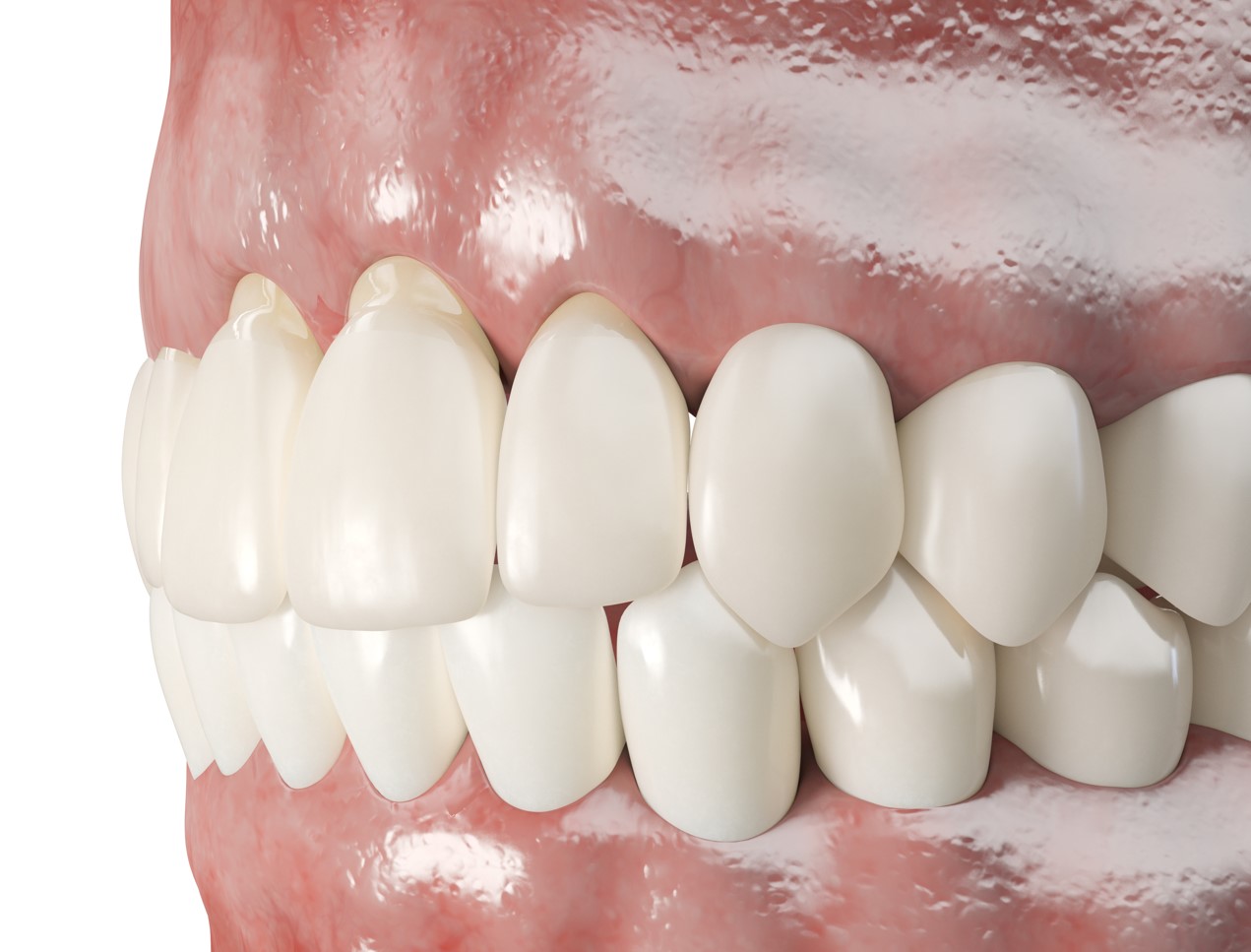 Can Receding Gums Grow Back Spring And Champions TX Dentist